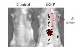 新的方法改善了动脉粥样硬化斑块的成像和进展