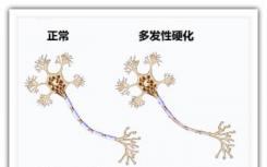 科学家发现治疗多发性硬化的新机制