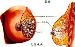 由糖皮质激素促进乳腺癌的传播