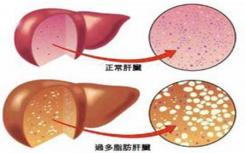 新分子可以帮助对抗2型糖尿病和非酒精性脂肪性肝病