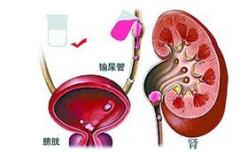 科学家发现第一个涉及下尿路梗阻的基因