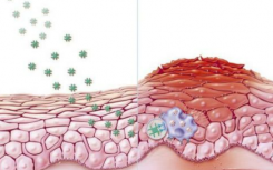 带状疱疹在全身治疗的牛皮癣中没有风险