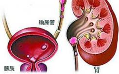 新发现可以改善肾结石疾病的诊断和早期筛查
