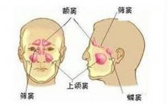 老年患者的独特慢性鼻窦炎形式