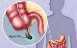 发现阑尾炎和过敏症之间的联系