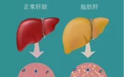 在美国丢弃的许多肾脏将被移植到法国