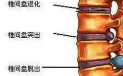 预防椎间盘突出症的装置在挫折后获得PMA