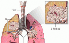 研究发现人工智能可以识别图像中的肺癌类型