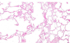 通过黏液摆动的纳米颗粒可能预示着严重的COPD