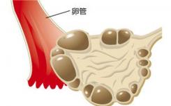 中国研究人员找到治疗多囊卵巢综合征的新目标