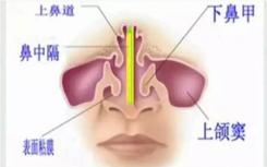 研究小组建议在治疗成人鼻窦炎时共同决策