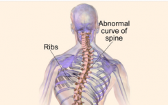 严重脊柱侧弯与必需饮食矿物质锰有关