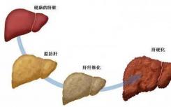 研究将肥胖人群的脂肪肝与心力衰竭联系起来