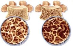 如何处理类固醇诱导的骨质疏松症