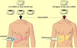 食用咖啡 凉茶可预防肝纤维化