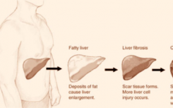 研究人员确定了引起肝纤维化的蛋白
