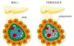 发现削弱1型糖尿病Treg分化和稳定性的新机制