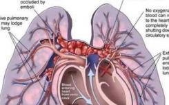 医生应对疑似肺栓塞的患者进行分层 以确定诊断策略