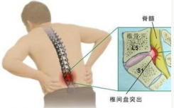 科普腰突患者注意饮食没那么难及不吃油条和辛辣可避开老年痴呆症